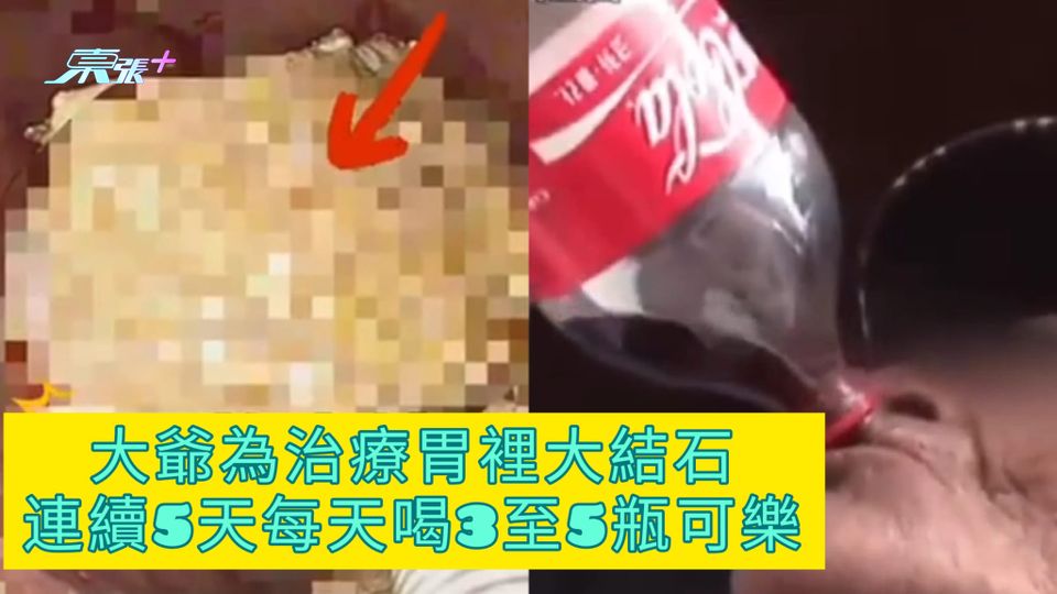 大爺為治療胃裡大結石 連續5天每天喝3至5瓶可樂