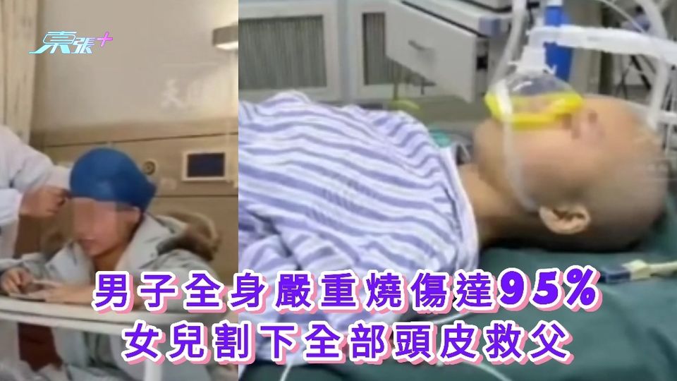 有片|男子全身嚴重燒傷達95% 女兒割下全部頭皮救父