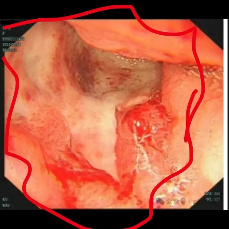 ▲小雯（化名）透過院方公開自己的內視鏡圖，以自身經歷，呼籲外界要注意自己的身體。（圖／翻攝自微博）