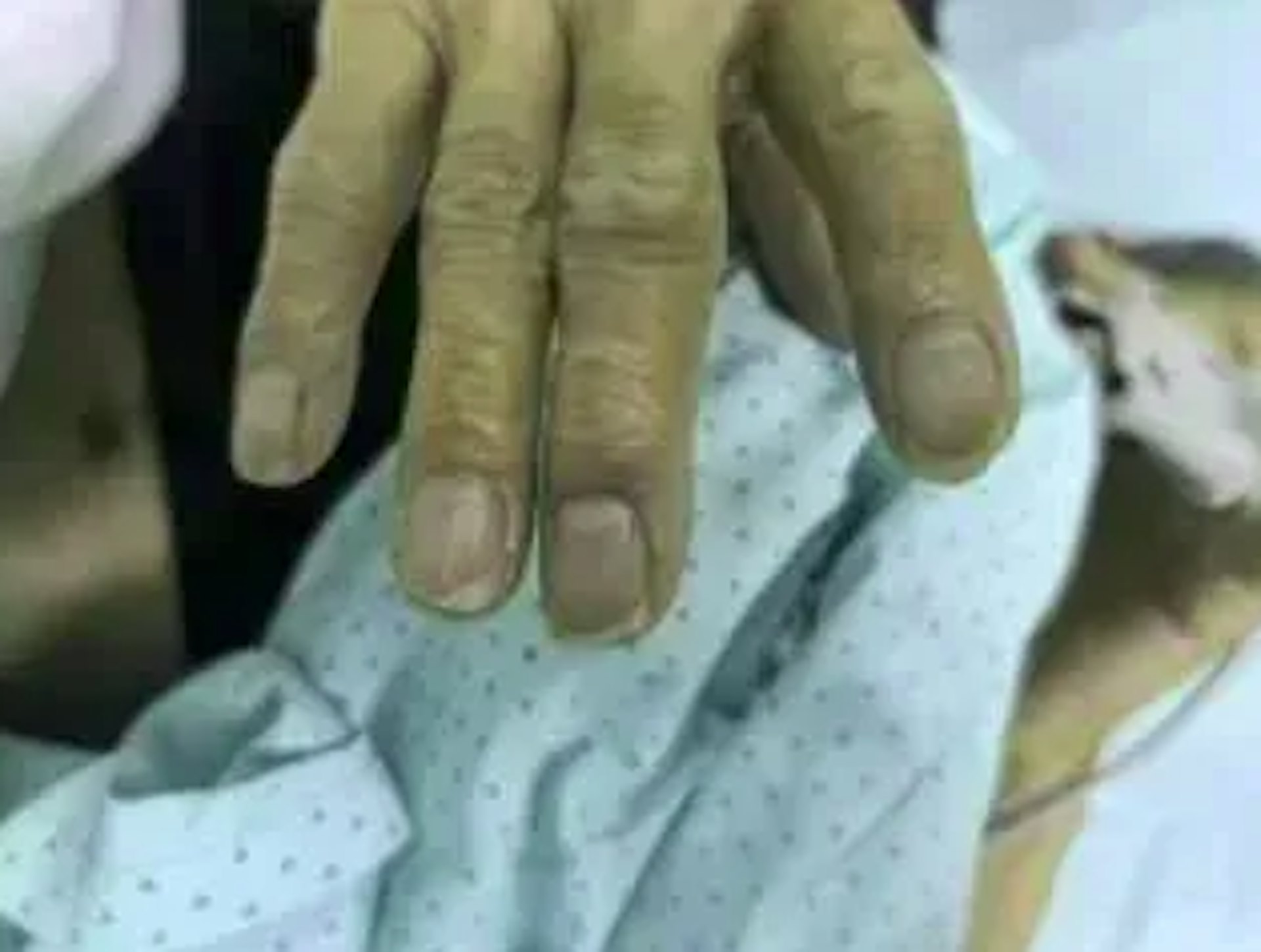 王先生嘴唇和指甲青紫得像塗了藍墨水。（網上圖片）