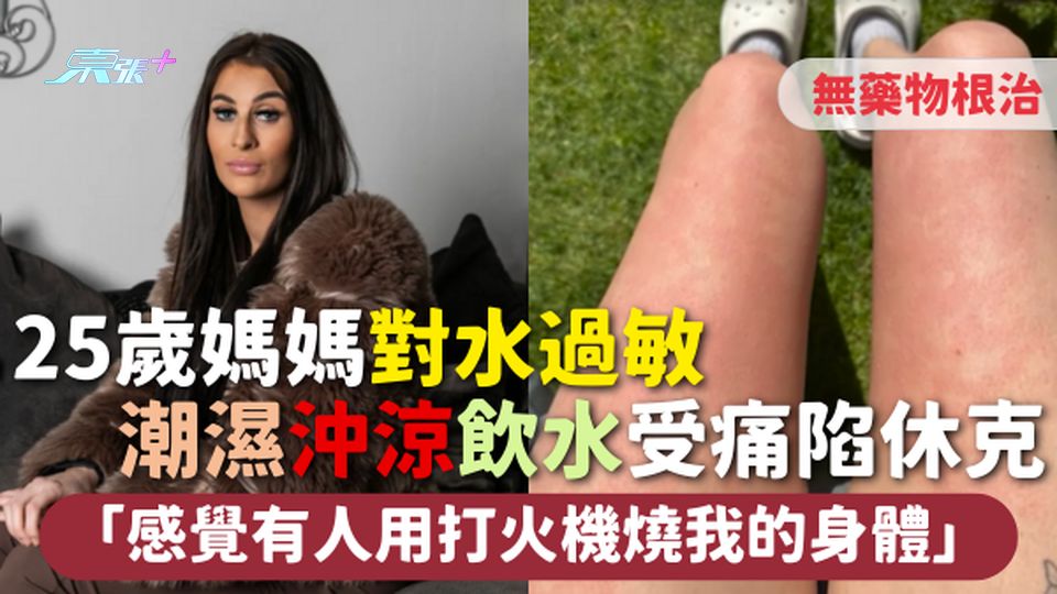罕見病 | 25歲媽媽對水過敏 潮濕沖涼飲水受痛陷休克 「感覺有人用打火機燒我的身體」