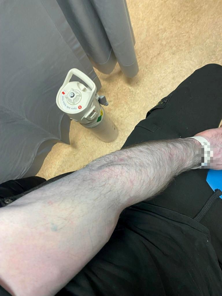 Tommy Lynch's arm with blue skin from bedsheet dye in a hospital.