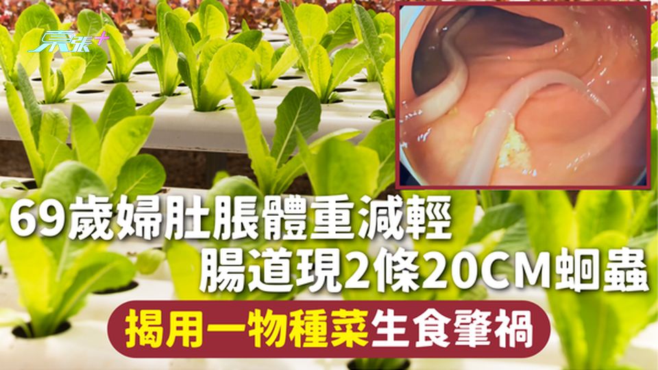 寄生蟲 | 69歲婦肚脹體重減輕 腸道現2條20cm蛔蟲 揭用一物種菜生食肇禍【有圖慎入】