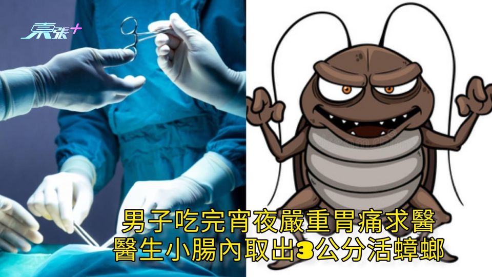 男子吃完宵夜嚴重胃痛求醫 醫生小腸內取出3公分活蟑螂