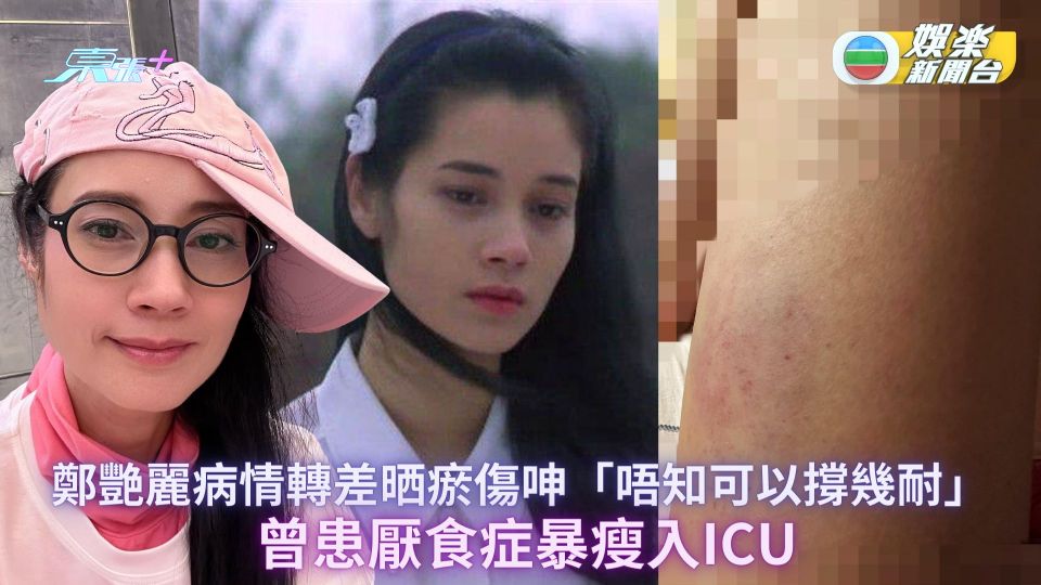 52歲鄭艷麗病情轉差晒瘀傷呻「唔知可以撐幾耐」 曾患厭食症暴瘦入ICU