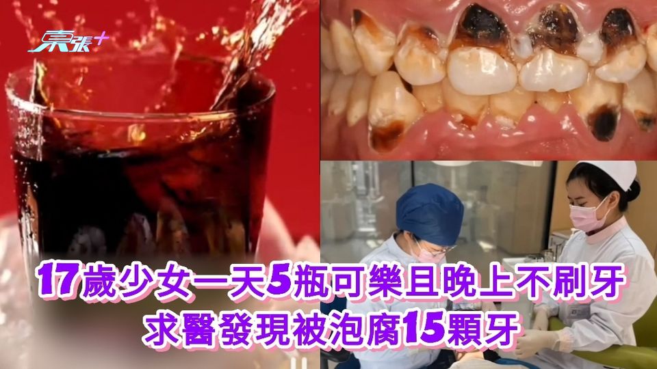 有片|17歲少女一天5瓶可樂且晚上不刷牙 求醫發現被泡腐15顆牙