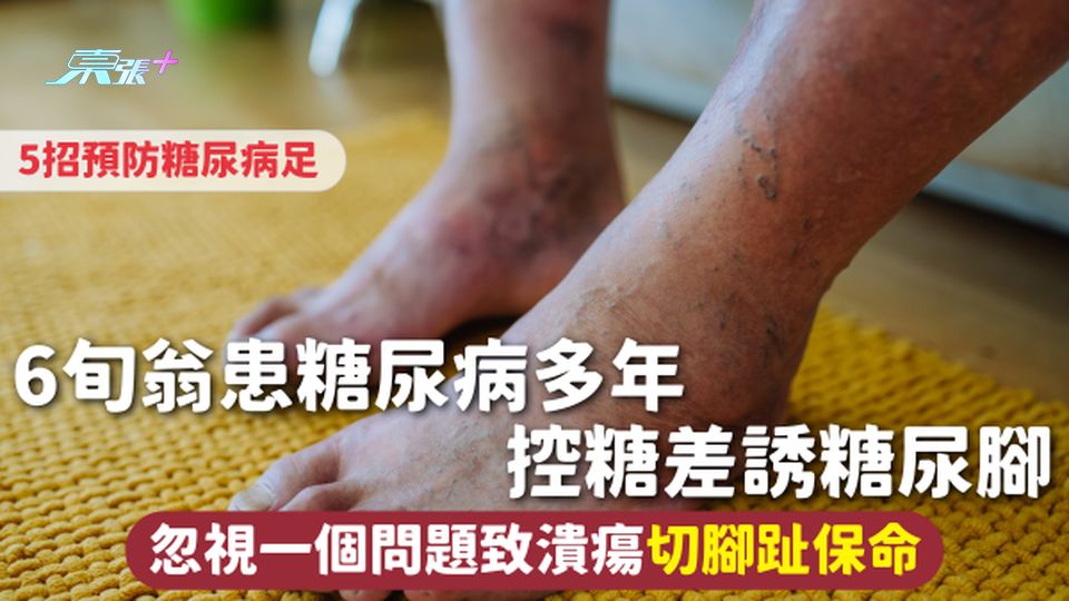 糖尿病足 | 6旬翁患糖尿病多年 控糖差誘糖尿腳 忽視一個問題致潰瘍切腳趾保命 附5招預防