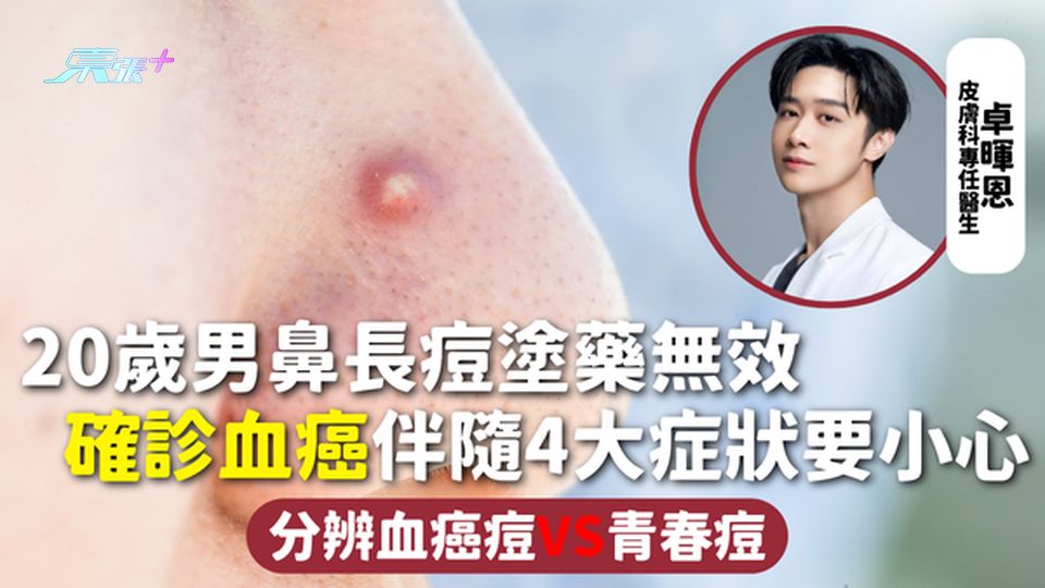 血癌 | 20歲男鼻長痘塗藥無效 確診血癌伴隨4大症狀要小心 分辨血癌痘VS青春痘