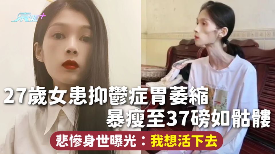 悲慘故事 | 27歲女患抑鬱症胃萎縮 暴瘦至37磅如骷髏 悲慘身世曝光：我想活下去