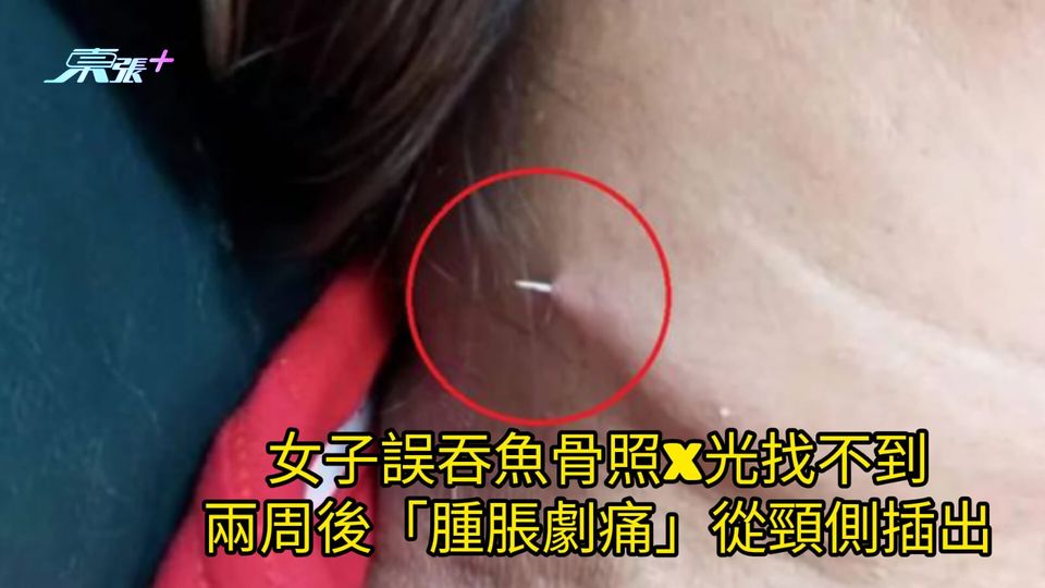 女子誤吞魚骨照X光找不到 兩周後「腫脹劇痛」從頸側插出