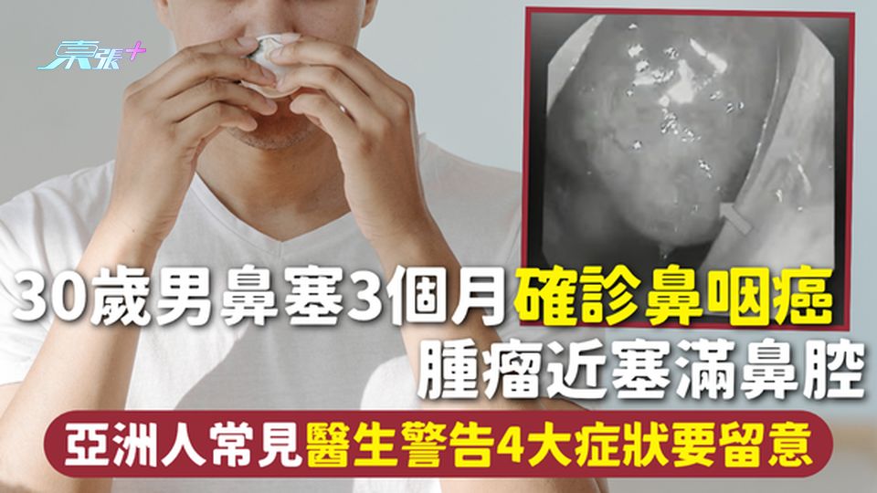鼻咽癌 | 30歲男鼻塞3個月確診鼻咽癌 腫瘤近塞滿鼻腔 亞洲人常見醫生警告4大症狀要留意