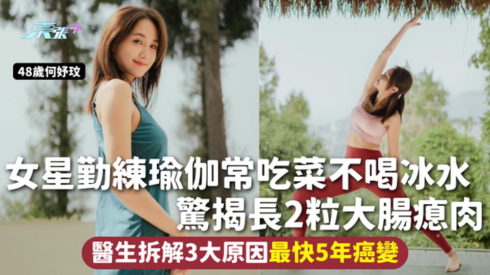 大腸瘜肉 | 48歲女星勤練瑜伽常吃菜不喝冰水 驚揭長2粒大腸瘜肉 醫生拆解3大原因最快5年癌變