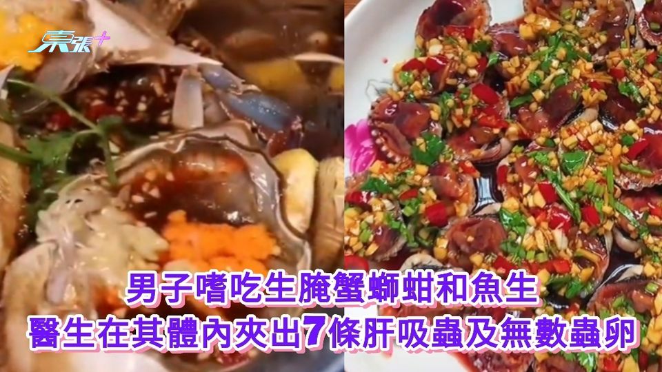 男子嗜吃生腌蟹螄蚶和魚生 醫生在其體內夾出7條肝吸蟲及無數蟲卵