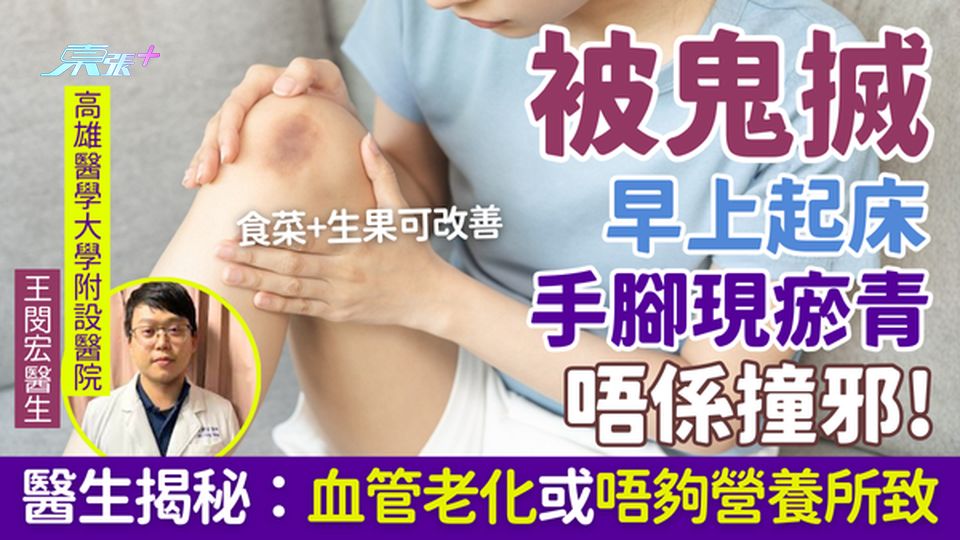 被鬼搣｜早上起床手腳現瘀青唔係撞邪！醫生揭秘：血管老化或唔夠營養所致 食菜+生果可改善