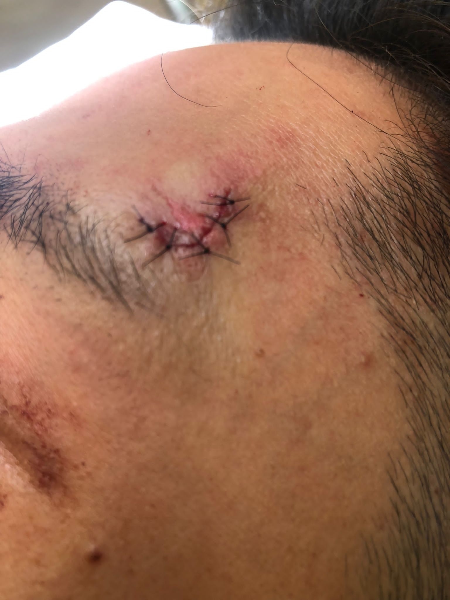 傷口被縫上七針呈現「L」型