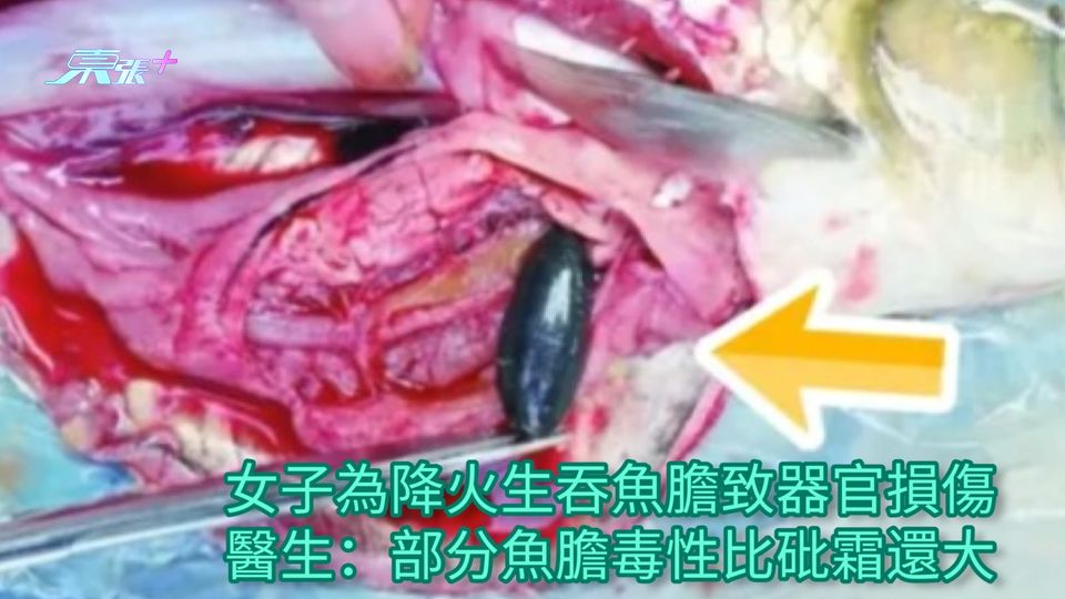 女子為降火生吞魚膽致器官損傷 醫生：部分魚膽毒性比砒霜還大