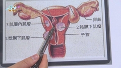 《最強生命線》：子宮肌瘤 今晚八點半財經體育資訊台