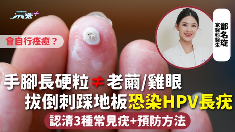 皮膚健康 | 手腳長硬粒≠老繭/雞眼 拔倒刺踩地板恐染HPV長疣會自行痊癒？認清3種常見疣+預防方法