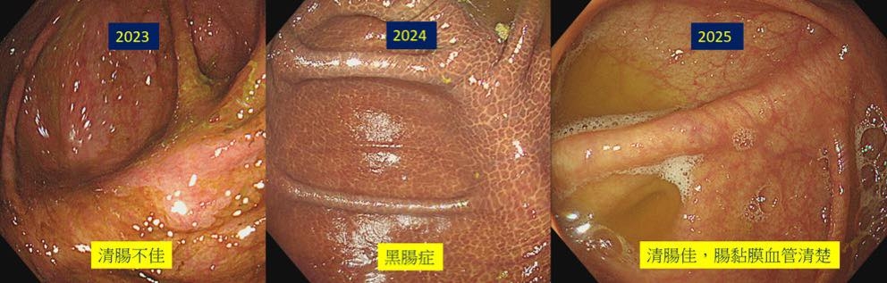 May be an image of 1 person and text that says '2023 2024 2025 清腸不佳 黑腸症 清腸佳 佳，腸黏膜血管清楚'
