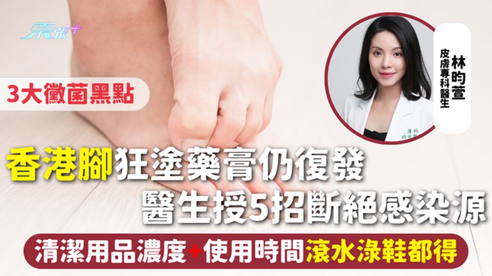 香港腳 | 狂塗藥膏仍復發 醫生授6招斷絕感染源 3大黴菌黑點 清潔用品濃度+使用時間 滾水淥鞋都得