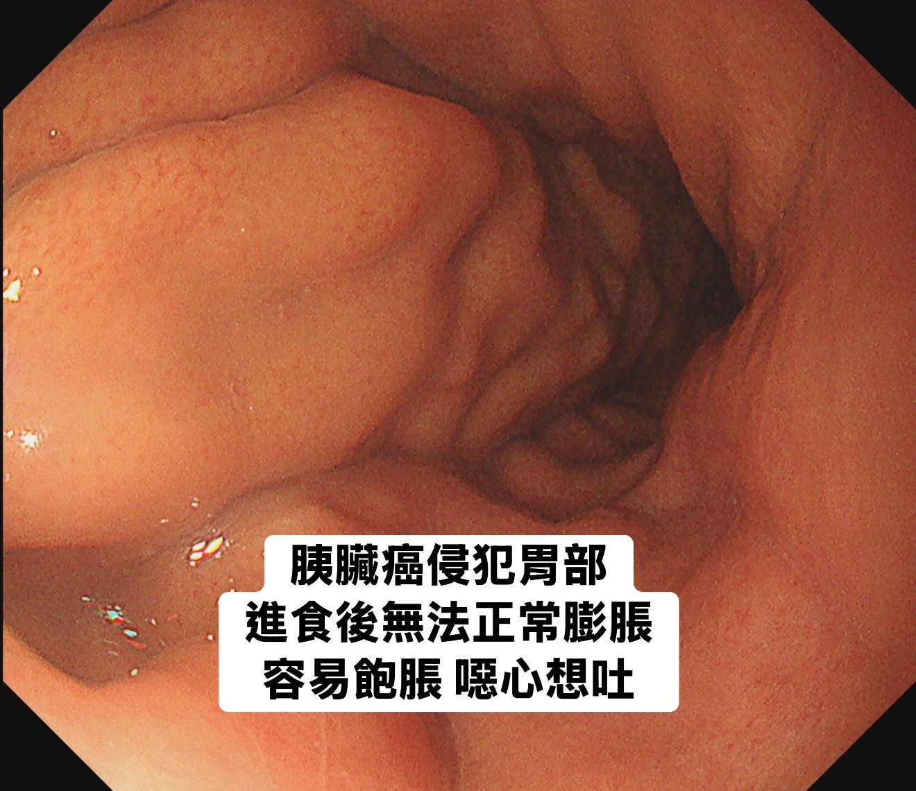 May be an image of text that says '胰臟癌侵犯胃部 進食後無法正常膨脹 容易飽脹 容易飽脹噁心想吐 惡心想吐'
