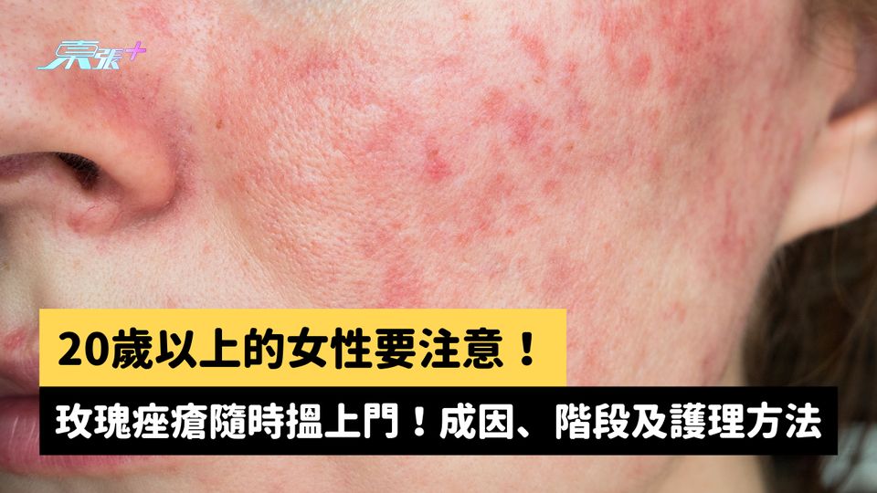 20歲以上的女性要注意！玫瑰痤瘡隨時搵上門！揭露成因、發作階段及有效護理方法  #至識健康 
