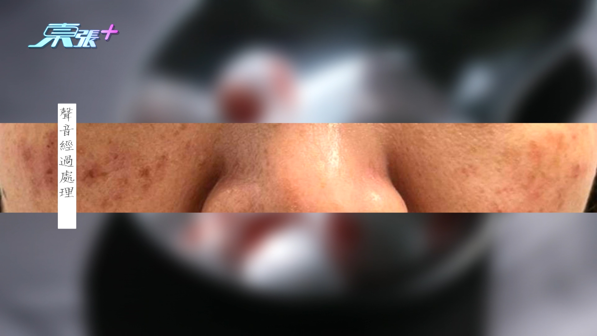 在療程前，美容師聲稱療程溫和且無風險，但過程中苦主感到劇痛並要求停止，卻遭忽視，最終導致臉部紅腫、出血並留下疤痕。