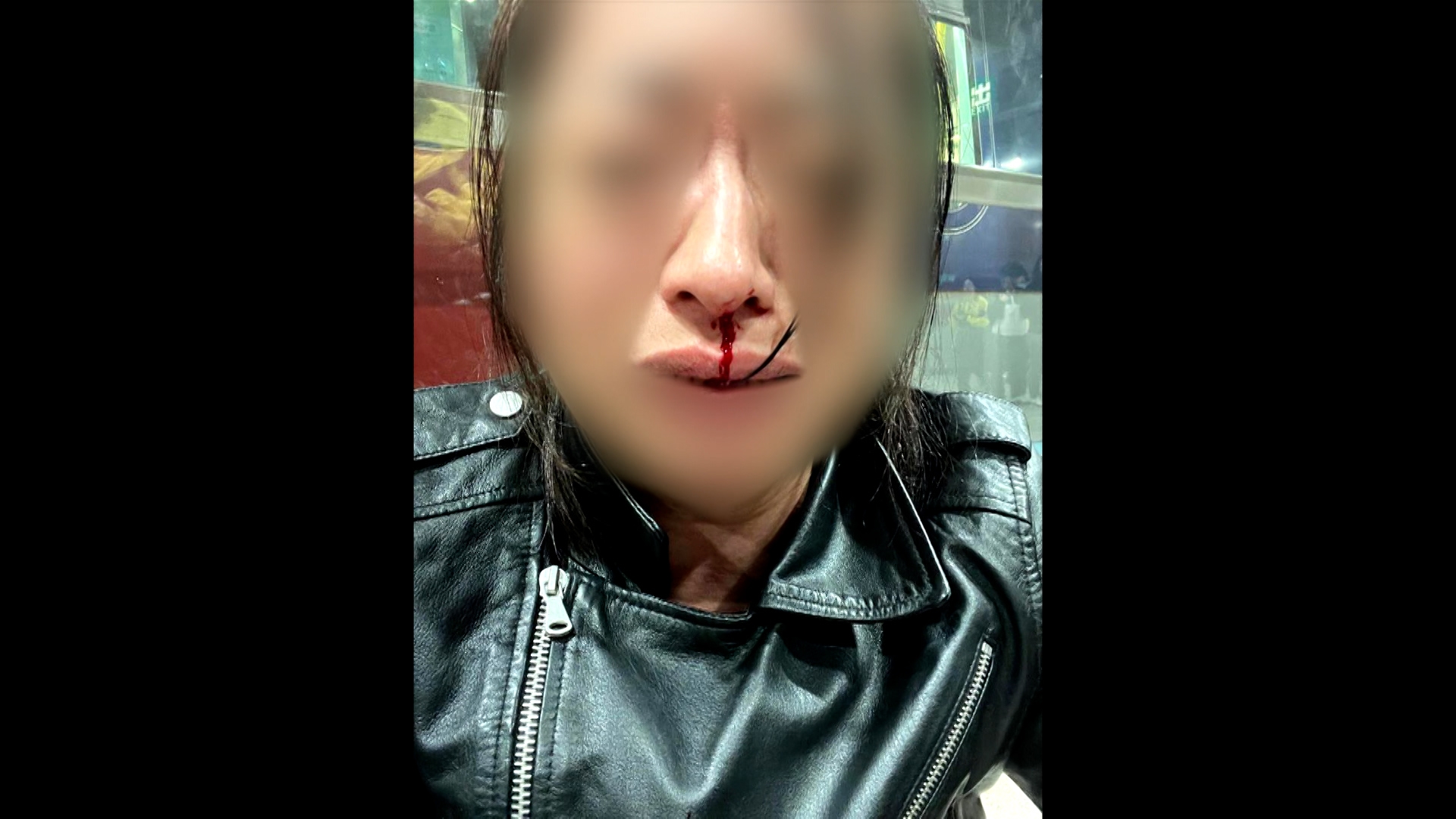 觀眾陳小姐向《東張西望》報料，她於1月23日乘車到荃灣西時被人襲擊，致使她流血不止，還要住院。