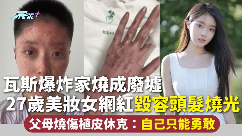 家居意外 | 瓦斯爆炸家燒成廢墟 27歲美妝女網紅毀容頭髮燒光 父母燒傷植皮休克：自己只能勇敢