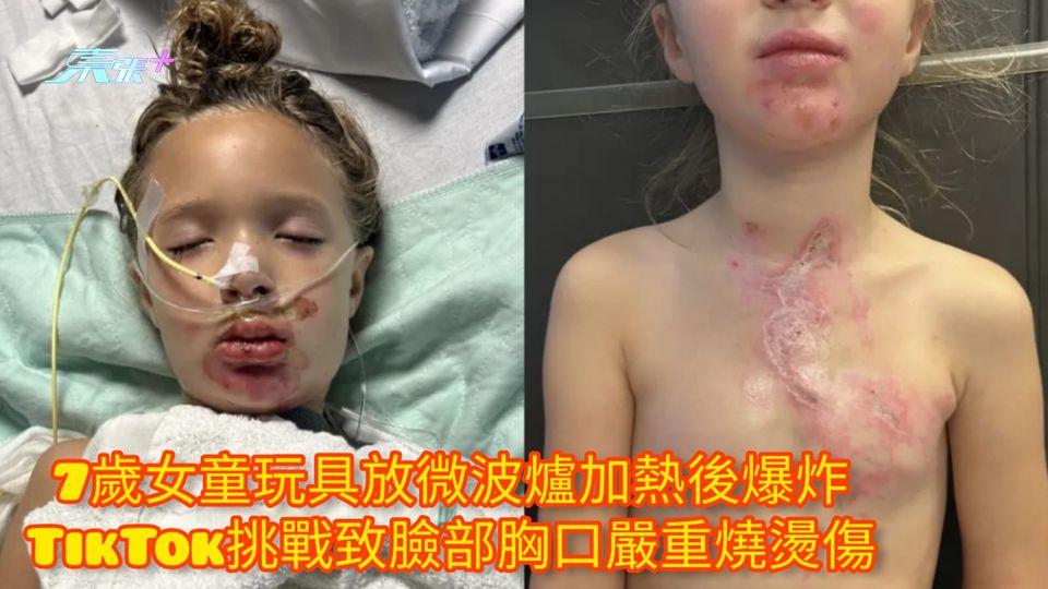 7歲女童玩具放微波爐加熱後爆炸 TikTok挑戰致臉部胸口嚴重燒燙傷