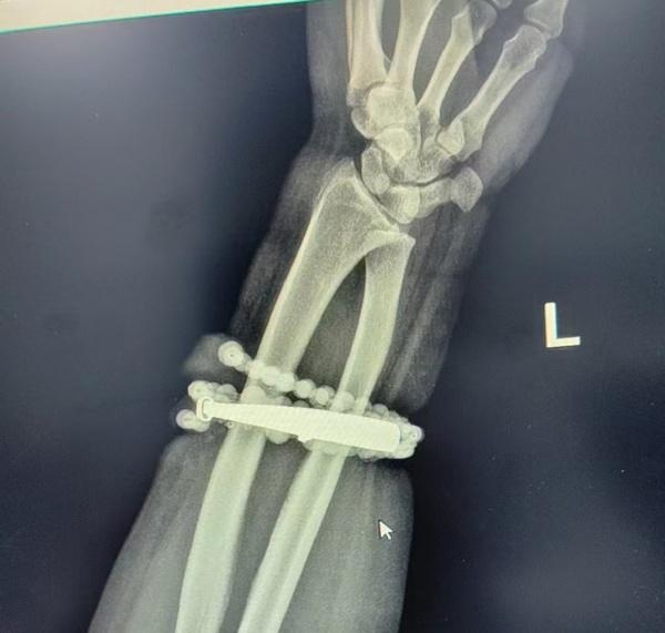 手鐲、佛珠戴10年沒摘！發福「嵌進肉裡」 手腕化膿血肉模糊│TVBS新聞網