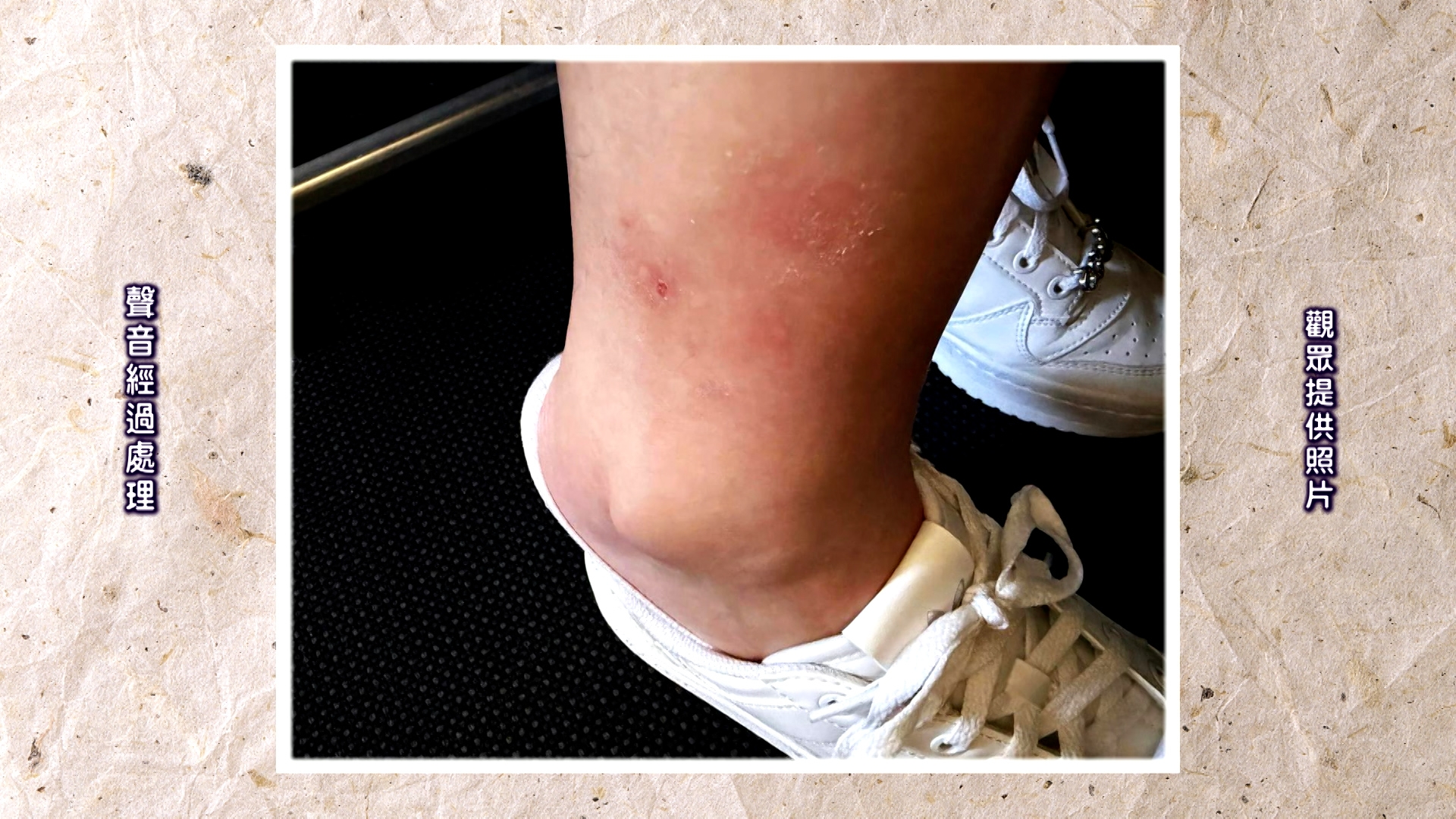 傷處當場紅腫疼痛，半個月後仍留有明顯紅印，恐會留下疤痕。