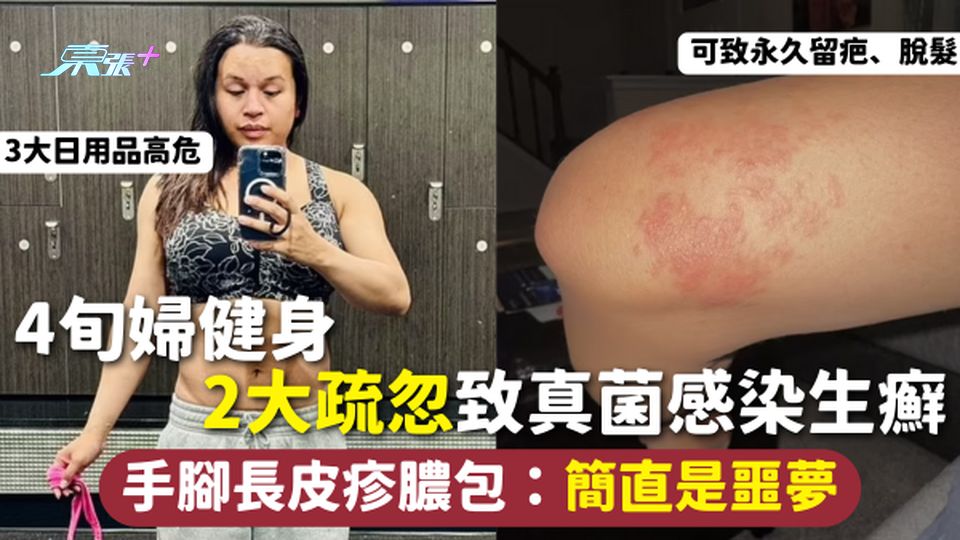 真菌感染 | 4旬婦健身 2大疏忽致真菌感染生癬 手腳長皮疹膿包：簡直是噩夢 3大日用品高危