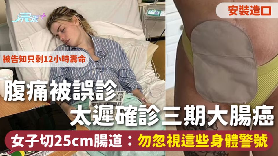 大腸癌 | 腹痛被誤診 太遲確診三期大腸癌 女子切25cm腸道：勿忽視這些身體警號
