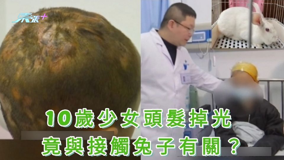 有片｜10歲少女頭髮掉光 竟與接觸兔子有關？