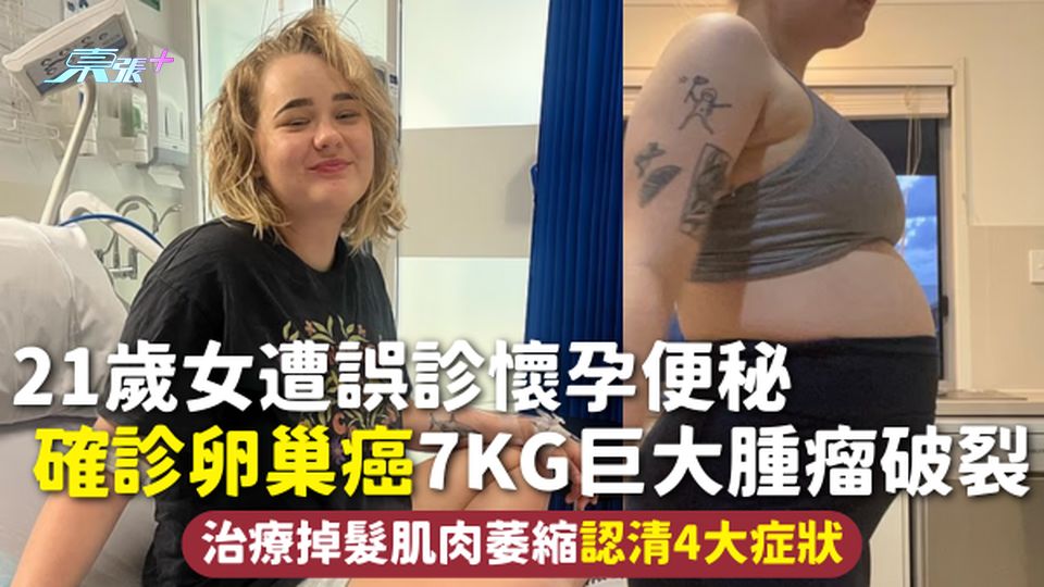 卵巢癌 | 21歲女遭誤診懷孕便秘 確診卵巢癌7kg巨大腫瘤破裂 治療掉髮肌肉萎縮認清4大症狀