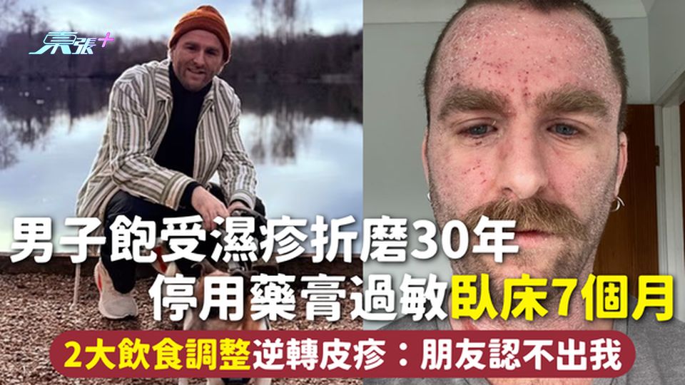 濕疹 | 男子飽受濕疹折磨30年 停用藥膏過敏臥床7個月 2大飲食調整逆轉皮疹：朋友認不出我