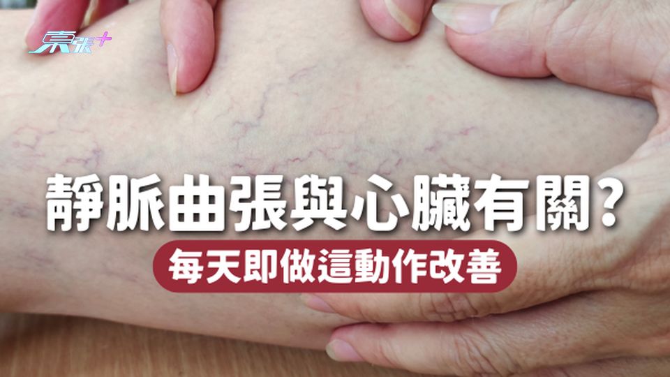 小腿有樹筋？靜脈曲張原來與心臟有關！每天做這動作5分鐘即可改善🦶🏻
