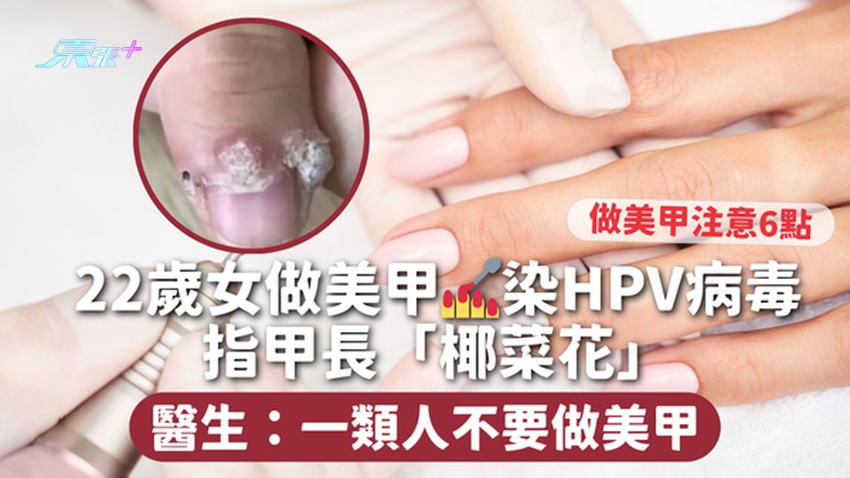 美甲惹禍 | 22歲女做美甲💅染HPV病毒 指甲長「椰菜花」醫生：一類人不要做美甲