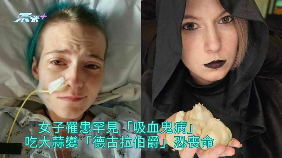 女子罹患罕見「吸血鬼病」 吃大蒜變「德古拉伯爵」恐喪命