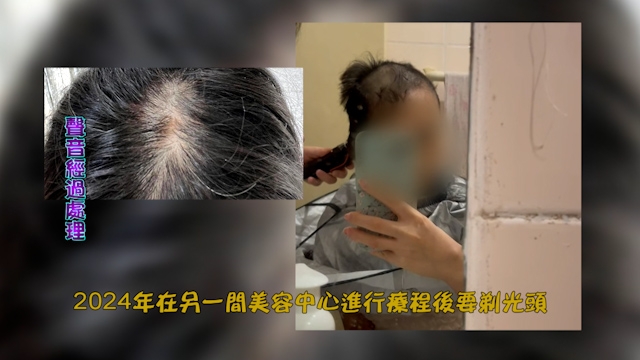 為了生回頭髮，她試過不同方法。她透露，兩年前另一次生髮療程更嚴重，要剃光頭才慢慢好回來，當時亦曾向消委會求助。