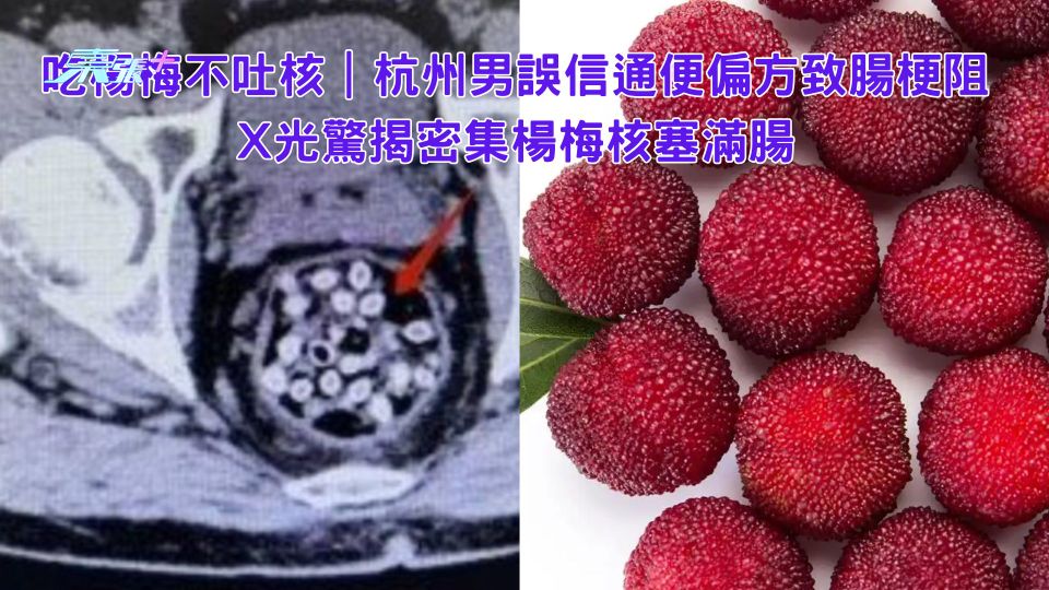 吃楊梅不吐核｜杭州男誤信通便偏方致腸梗阻 X光驚揭密集楊梅核塞滿腸