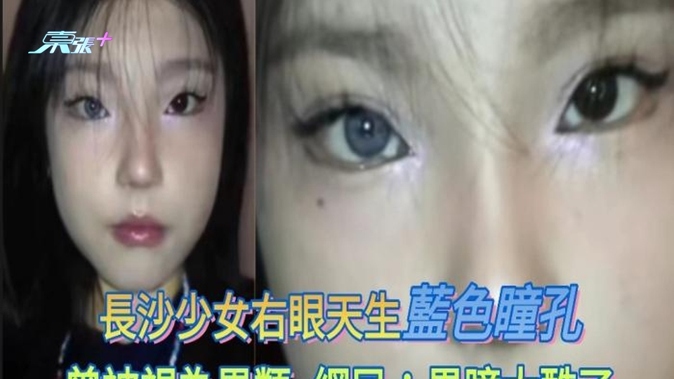 長沙少女右眼天生藍色瞳孔 曾因被視為異類而自卑 網民：異瞳太酷了
