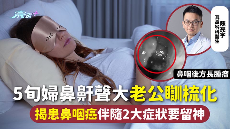 鼻咽癌 | 5旬婦鼻鼾聲大 老公瞓梳化 揭患鼻咽癌伴隨2大症狀要留神 未必只是鼻竇炎