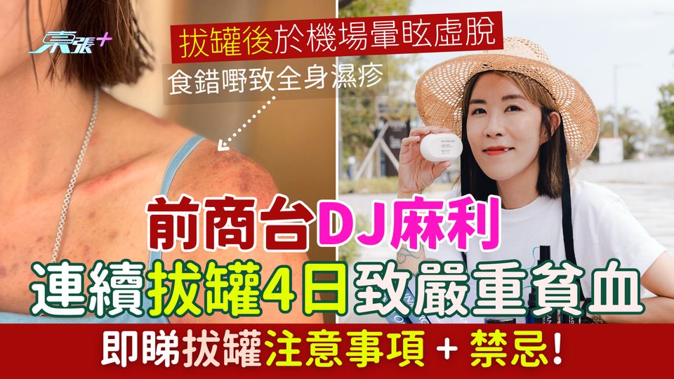 拔罐｜前商台DJ麻利連續拔罐4日致嚴重貧血 於機場暈眩虛脫 即睇拔罐注意事項+禁忌