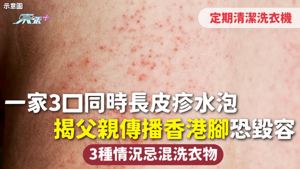 真菌感染 | 一家3口同時長皮疹水泡 揭父親傳播香港腳恐毀容 3種情況忌混洗衣物定期清潔洗衣機