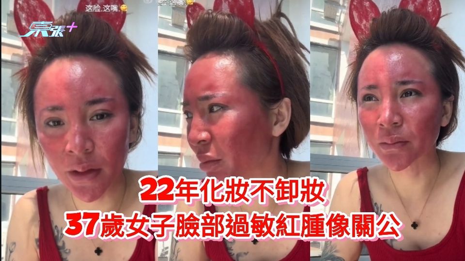 有片丨22年化妝不卸妝 37歲女子臉部過敏紅腫像關公