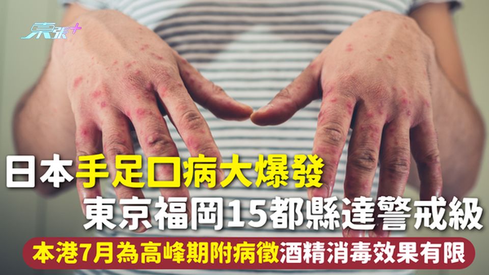 手足口病｜日本手足口病大爆發 東京福岡15都縣達警戒級 本港7月為高峰期附病徵 酒精消毒效果有限