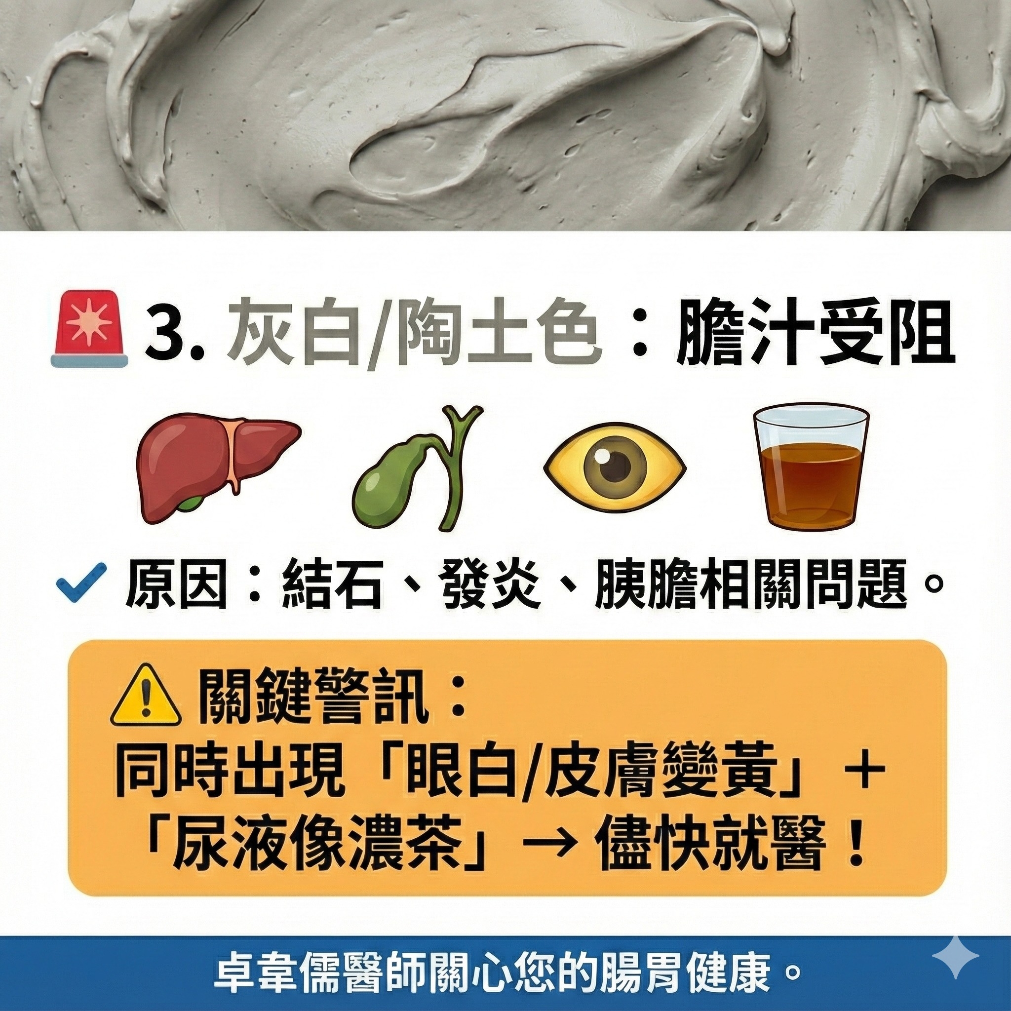 May be an image of ‎text that says '‎3.灰白/陶土色：膽汁受阻 灰白/陶土色： 陶土色： 3. 灰白 膽汁受阻 صد 原大： 原因：結石、發炎、胰膽相關問 原因：結石、 發炎、 結石、 胰膽相關問題。 ! 關鍵警訊： 同時出現 「眼白/皮膚變黃」 「眼白 皮膚變黃」 + 「尿液像濃茶」→儘快就醫！ → →儘快就醫！ 「尿液像濃茶」 卓章儒醫師關心您的腸胃健康。‎'‎