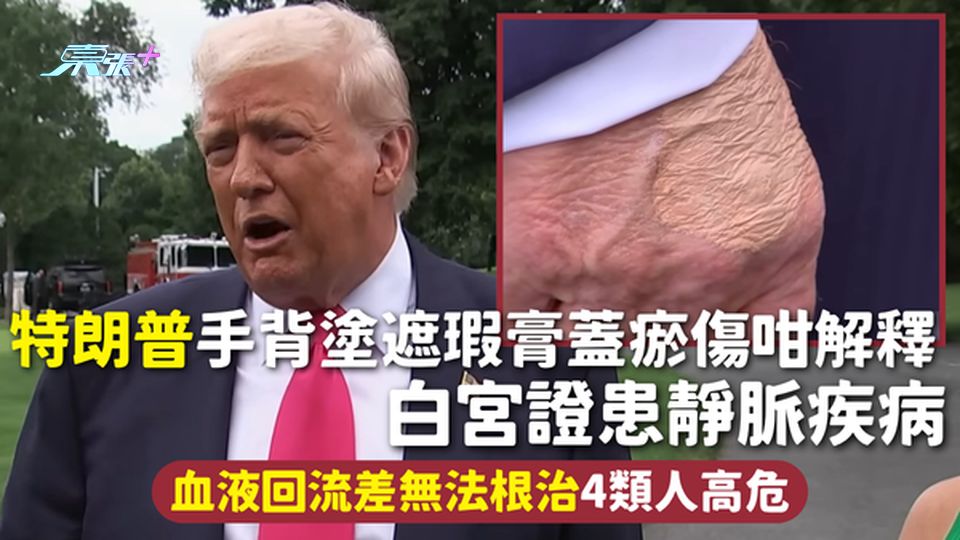 特朗普健康 | 特朗普手背塗遮瑕膏蓋瘀傷咁解釋 白宮證患靜脈疾病 血液回流差無法根治4類人高危